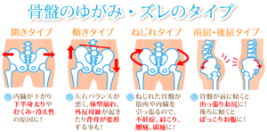 京都市 中京区 四条大宮 藤枝整骨院  骨盤の歪みの種類を描いたイラストです。