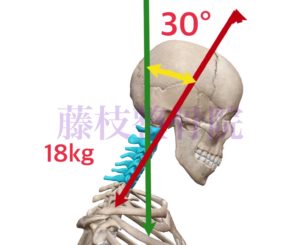京都市中京区四条大宮　藤枝整骨院　右側面から頭頸部と胸部の上部の骨格を見た図で頭部の角度を30℃、それによってかかる負担を18㎏としています